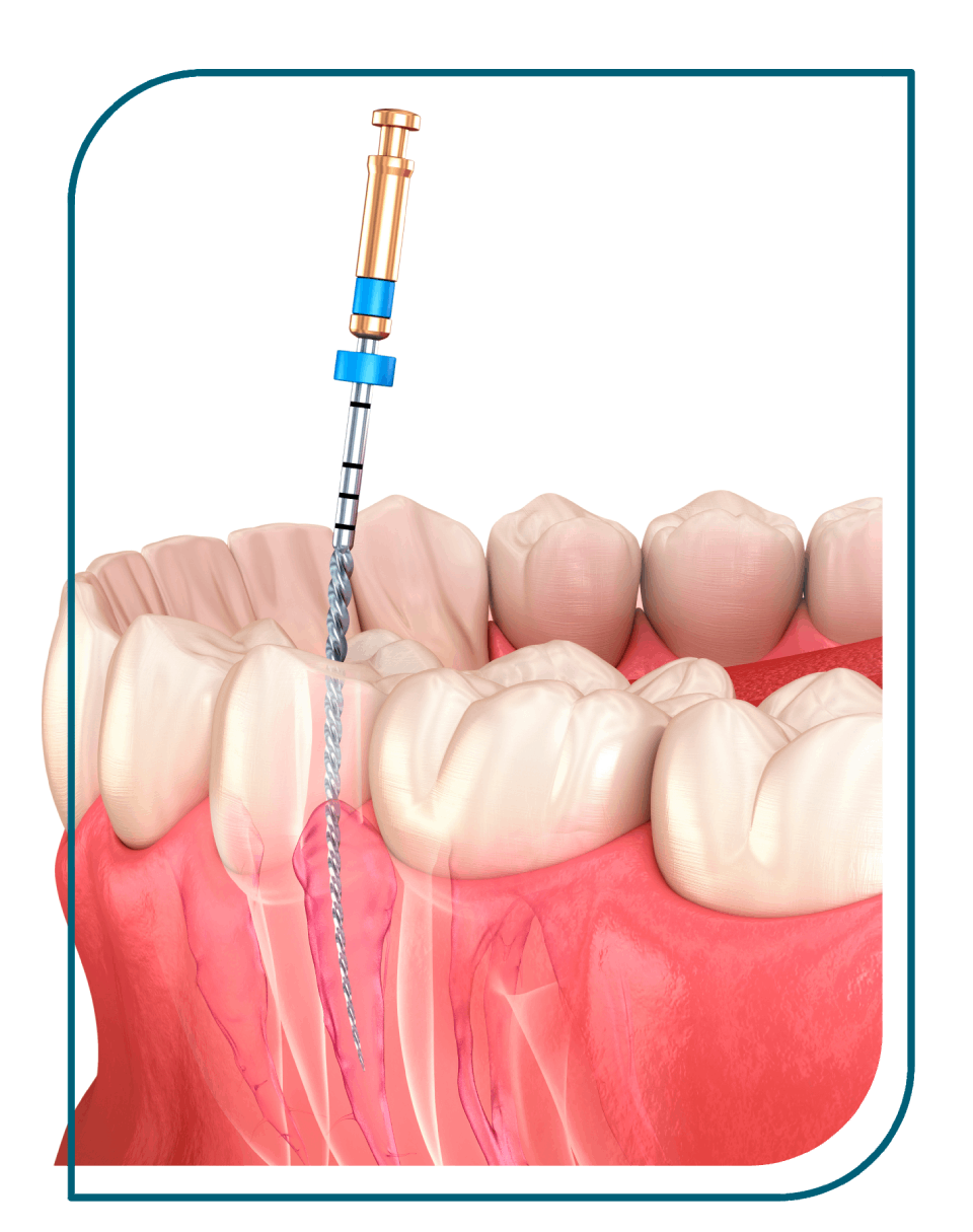 endodontie